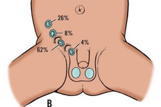 Tinh hoàn ẩn - Hình ảnh minh họa
